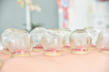 Closeup of cupping therapy on patient back,Chinese alternative medicine.