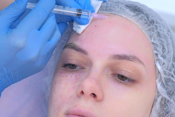 Cosmetologist doctor is making multiple injections biorevitalization in woman face on forehead...