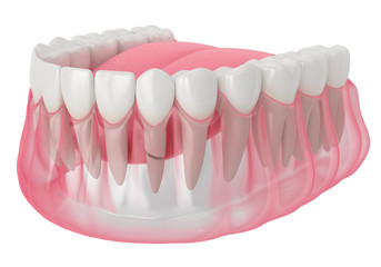 3d render of jaw with cracked tooth root