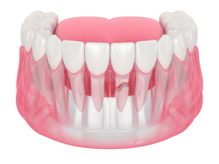 3d render of jaw with cracked tooth root