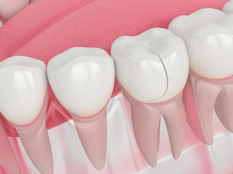 3d render of jaw with fractured tooth