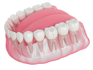 3d render of jaw with fractured tooth