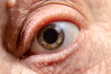 The blue eye of an old man with many brown specks on the iris.