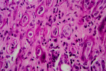 Obraz premium Chronic glomerulonephritis, light micrograph