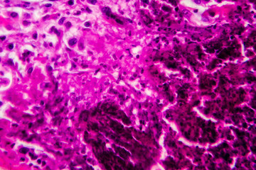 Acute pyelonephritis, light micrograph