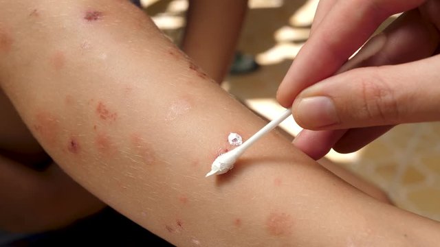 Applying ointment or curative creams in treatment of skin diseases. Bite of an insect. Applying the ointment in treatment and hydration of skin