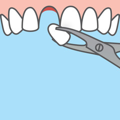 Blank banner Tooth extraction,tooth removal by forceps (upper) illustration vector design on blue background. Dental care concept.