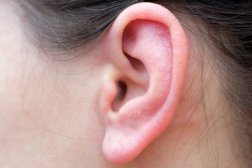 Girl's ear close-up. Sore red ear from allergies. Problems associated with auricle disease.