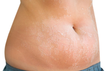 Sunburn on the female belly skin. Exfoliation, skin peels off.