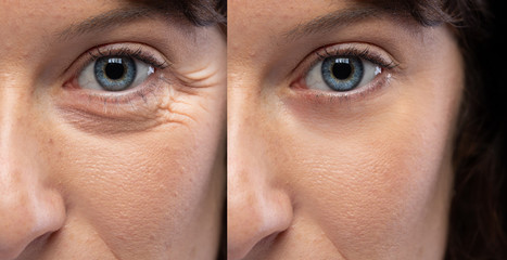Woman eyes before and after an anti age treatment for wrinkles and crow's feet - obrazy, fototapety, plakaty