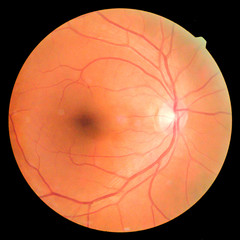 View inside human eye disorders - showing retina, optic nerve and macula.Medical photo tractional retinal detachment of diabetes.Eye treatment concept.select focus.
