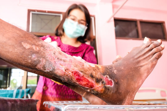 Inflammation of the legs, severe infectious hepatitis, treated by specialized skin doctors, ulcers, ulcers caused by low immunity.