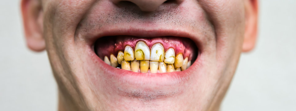 Plaque teeth cavities and paradontosis in the man's mouth. Dental decay problems and bad smile. Dentist treatment concept.