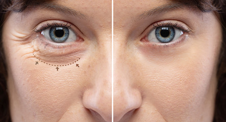 Before and after a rejuvination treatment, wrinkles and crow's feet removal Lines and arrows shows...