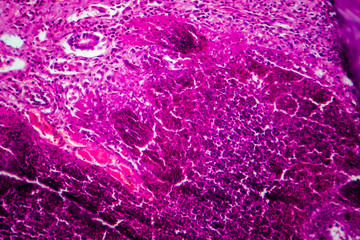 Acute pyelonephritis, light micrograph