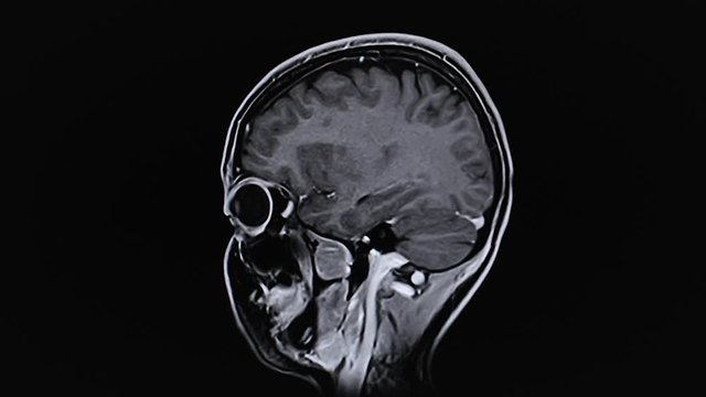 MRI brain scan,magnetic resonance imaging of a brain. Time lapse