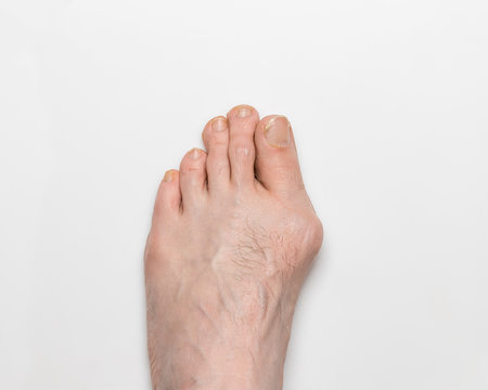 Closeup of left foot with bunion, hallux valgus, on big toe causing deformity