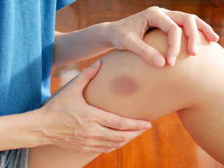 Woman's got a purple bruise