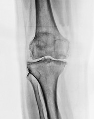 X-ray image of a knee 