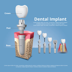 Human teeth and Dental implant Vector Illustration