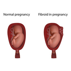 Fibroid and normal. Fetus in uterus, womb, placenta, umbilical cord. Hi-risk pregnancy complications. Medical anatomy illustration.