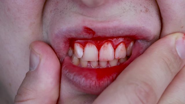 Gum bleeding and inflammation close up. A man examined by a dentist. The diagnosis of gingivitis
