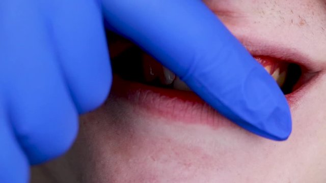 Gum bleeding and inflammation close up. A man examined by a dentist. The diagnosis of gingivitis