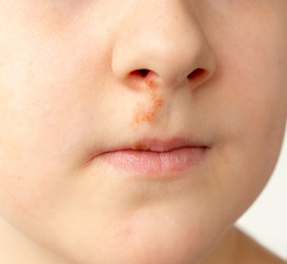 face of boy with herpes on his nose close up, Herpes simplex virus - obrazy, fototapety, plakaty