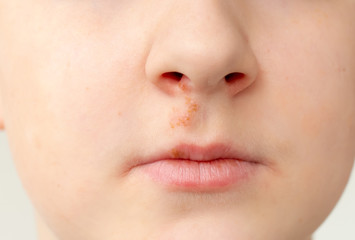 face of a kid with herpes on nose close up, genetic virus
