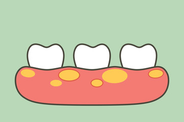 unhealthy teeth because gingivitis or gum disease with abscess in gum - dental cartoon vector flat style