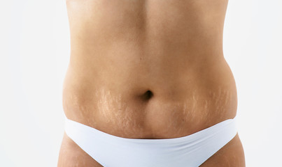 Fototapeta na wymiar Woman belly with stretch marks abdomen after pregnancy