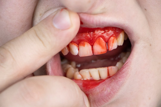 The man has blood on his teeth, severe bleeding of the gums after a blow to the jaw. Close-up of teeth after a fight or bruise