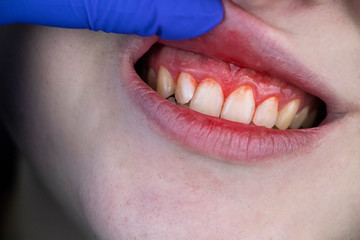 Gum bleeding and inflammation close up. A man examined by a dentist. The diagnosis of gingivitis