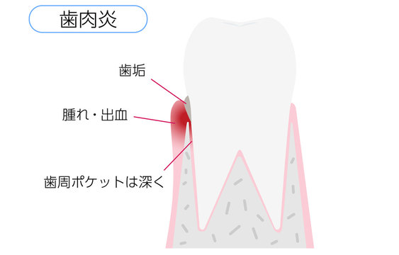 歯肉炎 Photos Royalty Free Images Graphics Vectors Videos Adobe Stock 歯肉炎 Photos Royalty Free Images Graphics Vectors Videos Adobe Stock