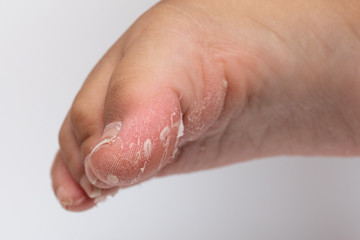 blisters and skin exfoliation: concept of foot health