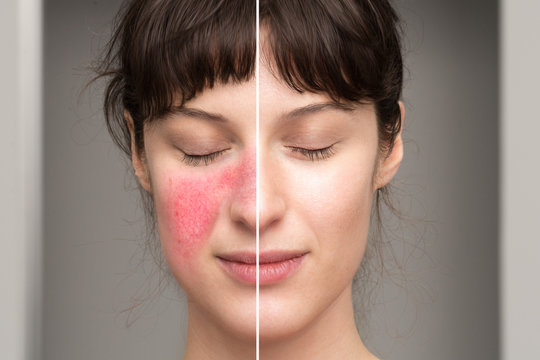 signs and symptoms of rosacea: natural cures in the treatment of skin disorders