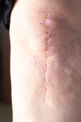 Naklejka premium Scar Treatments: types of scars and their treatments