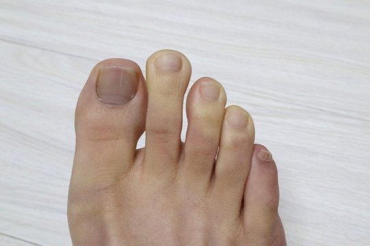 Raynaud's disease