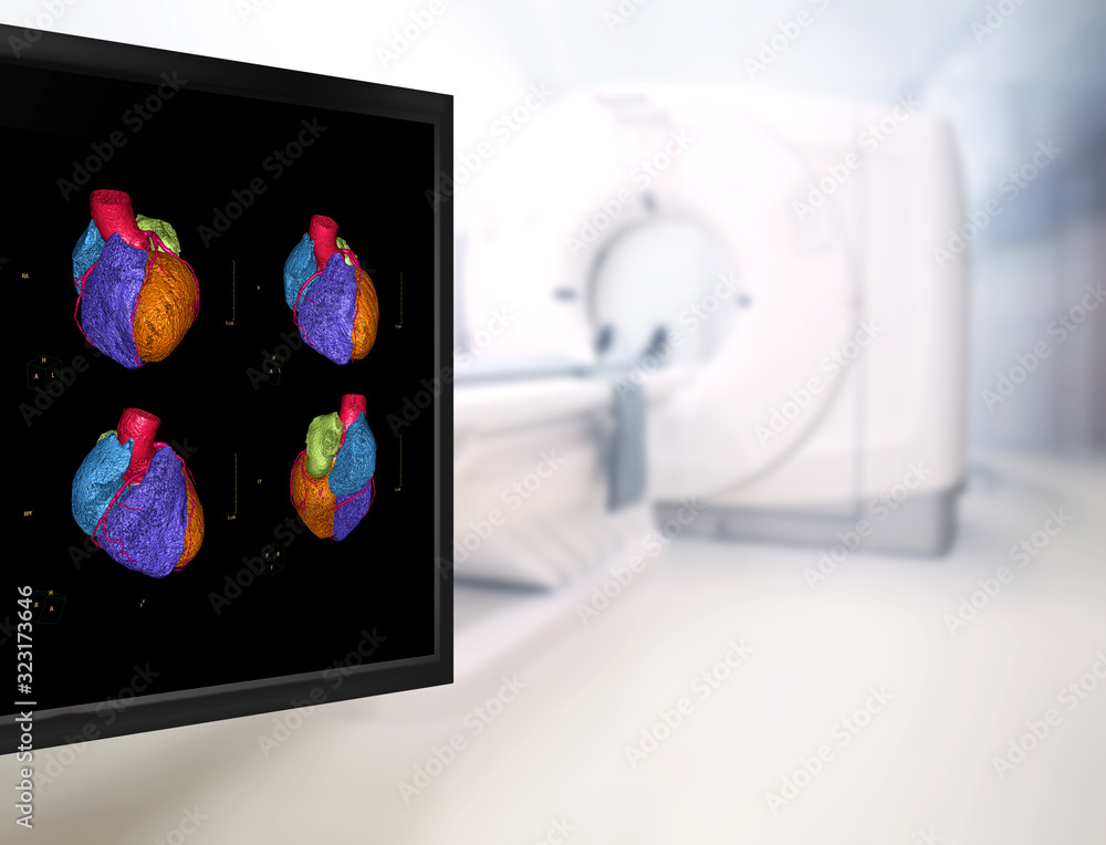 Poster selective focus of cta coronary artery 3d rendering image on the mornitor in ct scanner room at the 