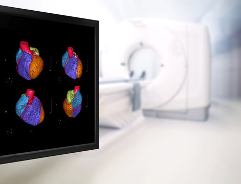 Selective focus of CTA Coronary artery  3D rendering image on the mornitor in CT Scanner room at the hospital.