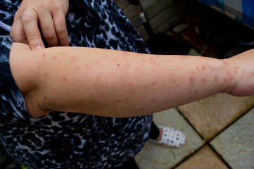 Bed bug bites, swelling and scars in multiple locations on the skin of a females arm from a residential property infested with common bedbugs, Cimex lectularius a biting insect parasite in the bedroom