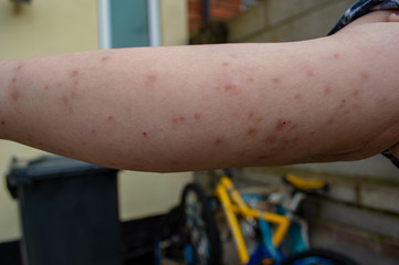 Bed bug bites, swelling and scars in multiple locations on the skin of a females arm from a...