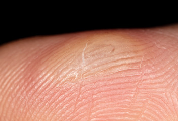 Corn on a finger isolated on a black