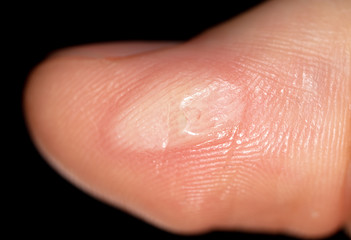 Corn on a finger isolated on a black