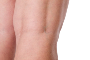 Fototapeta na wymiar Varicose veins under the skin of a woman on a white background