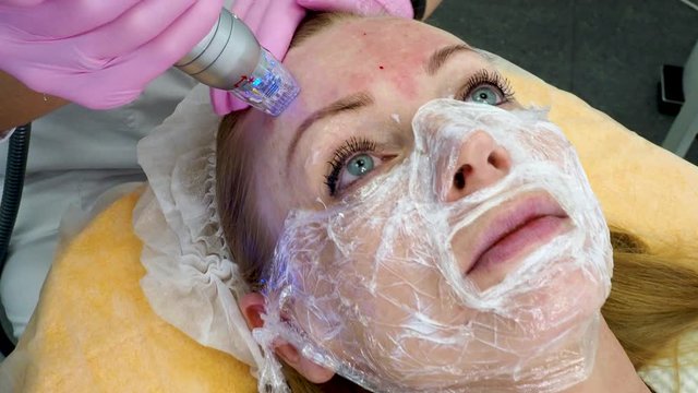 Fractional Microneedle Radio Frequency Apparatus. Beautician Making Skin Remodeling Using Radiofrequency Needle Lift. 4K