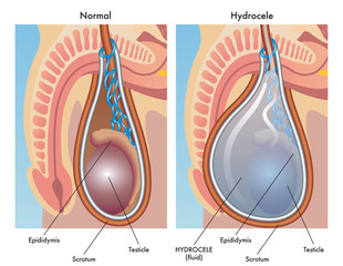 Medical illustration of hydrocele in male testicles showing inflammation before and after. © rob3000