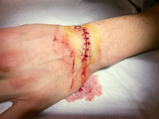 Injury from a cut on the wrist and hand resulting in stitches in the Emergency room