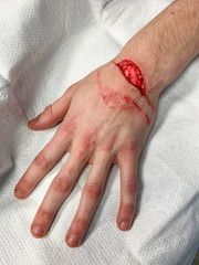 Injury from a cut on the wrist and hand requiring stitches in the Emergency room