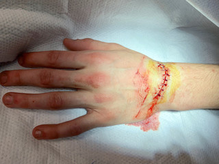 Injury from a cut on the wrist and hand resulting in stitches in the Emergency room